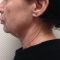 Mini lifting (lifting cervico-facial)