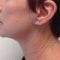 Mini lifting (lifting cervico-facial)
