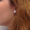 Mini lifting (lifting cervico-facial)