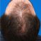 Hair Transplant