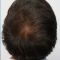 Hair Transplant