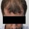 Hair Transplant