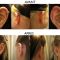 Otoplastie (Chirurgie esthétique des oreilles)