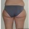Augmentation et modelage des fesses et des hanches