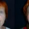 Facelift