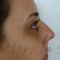 Septoplasty
