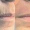 Fotorejuvenizácia /Resurfacing