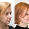 Facelift, SMAS Facelift