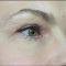 Restylane®