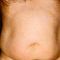 Liposukce