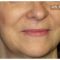 Injections de comblement