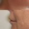 Facelift - Lifestyle lift