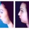 Chin Surgery
