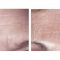 Botulinum toxin - Wrinkle Removal