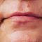 Lippenvergrößerung