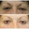 Eyelid surgery (Blepharoplasty)