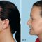 Facelift (operace obličeje), SMAS lifting