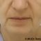 Facelift