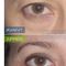 Blépharoplastie
