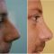 Operácia nosa (Rhinoplastika)