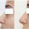 Rhinoplastie médicale
