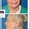 Lifting du visage