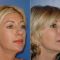 Dermal fillers