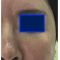 Lipofilling (grasso)