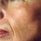Laserové zákroky estetické dermatologie