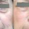 Blépharoplastie inférieure