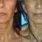 Lifting du visage
