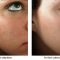 Radiofrekvenční rejuvenace - vyhlazení pleti (ShapeUp!, Aluma, Accent, TriPollar, Spa RF, Radiofrequency Re-Styling, Re-Age, Pellevé)
