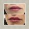 Lippenvergrößerung