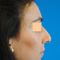 Rhinoplastie