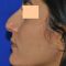 Rhinoplastie