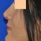 Rhinoplastie