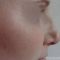 Operácia nosa (Rhinoplastika)