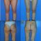 Chirurgie des cuisses