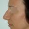 Plastika nosu (Rhinoplastika)
