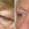 Eyelid surgery (Blepharoplasty)