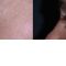 Forehead lift (Brow lift)