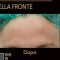 Lifting non chirurgico (Exilis)
