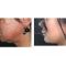 Liposuzione laser - Smart Lipo