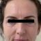 Facelift (operace obličeje), SMAS lifting