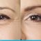 Korekcja powiek (Blepharoplastyka)