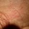 Traitements laser - dermatologie esthétique