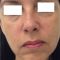 Ultherapy (Lifting non chirurgico)