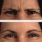 Botulinum toxin - Wrinkle Removal