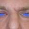 Eyelid surgery (Blepharoplasty)