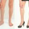 Varicose veins treatment